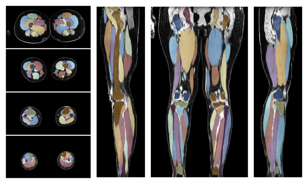 Overlay of automated muscle segmentation labels on dixon water image.